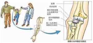 桡骨骨折保健