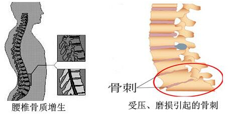 草莓视频入口仪的专业厂家阐述骨质增生与骨质疏松,仪器专业检测草莓视频入口正常值